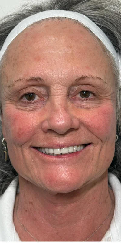 Before CO2 Skin Rejuvenation CO2 laser at Nurture Wellness