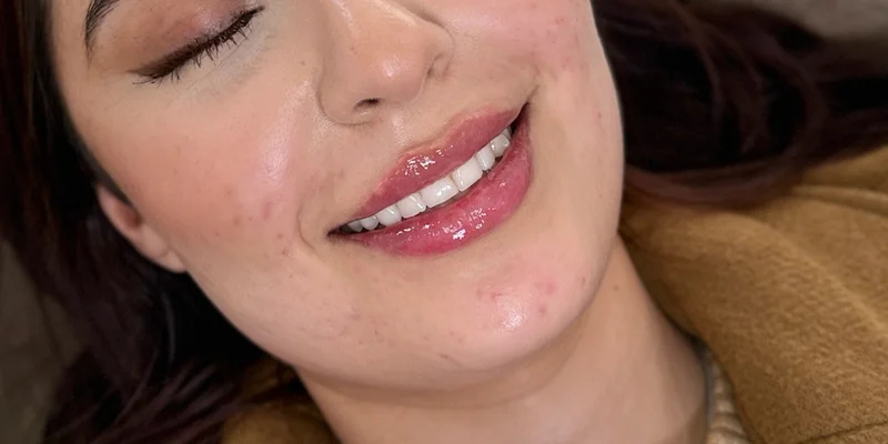 After: Lip Filler