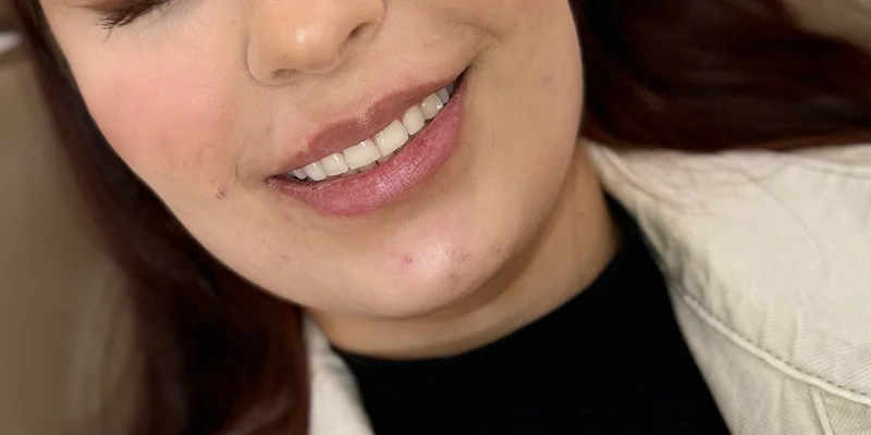 Before: Lip Filler