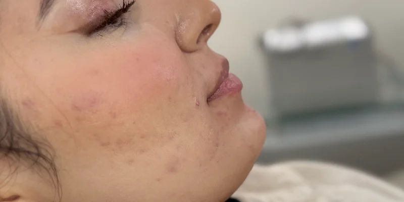 Before: Lip Filler