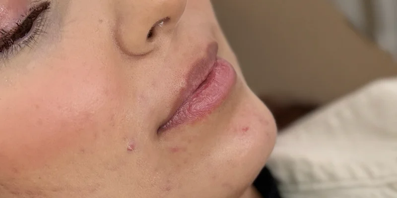 Before: Lip Filler