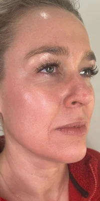 After: Microneedling + PRF - 4 sessions