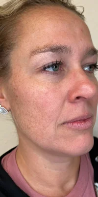 Before: Microneedling + PRF - 4 sessions