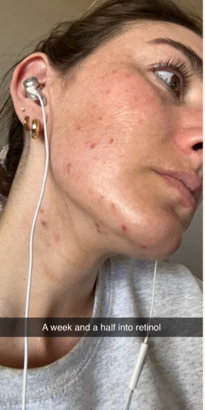 Before: Retinol and targeted interventions for clear skin