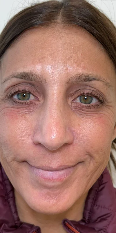 After: 6-month ZO Skin Health protocol for hormonal pigmentation