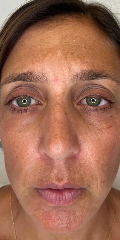 Before: 6-month ZO Skin Health protocol for hormonal pigmentation